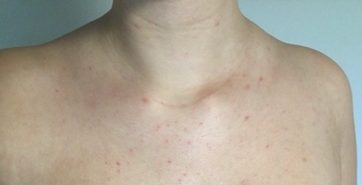 Body Acne on Chest
