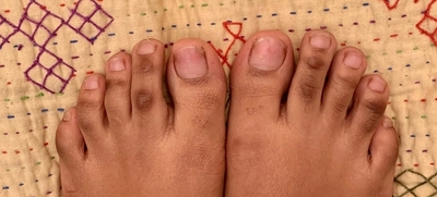 Discoloration on toes
