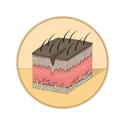 An illustration showing a stretch mark as a jagged tear in shin