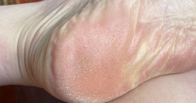 peeling, rough, weathered feet