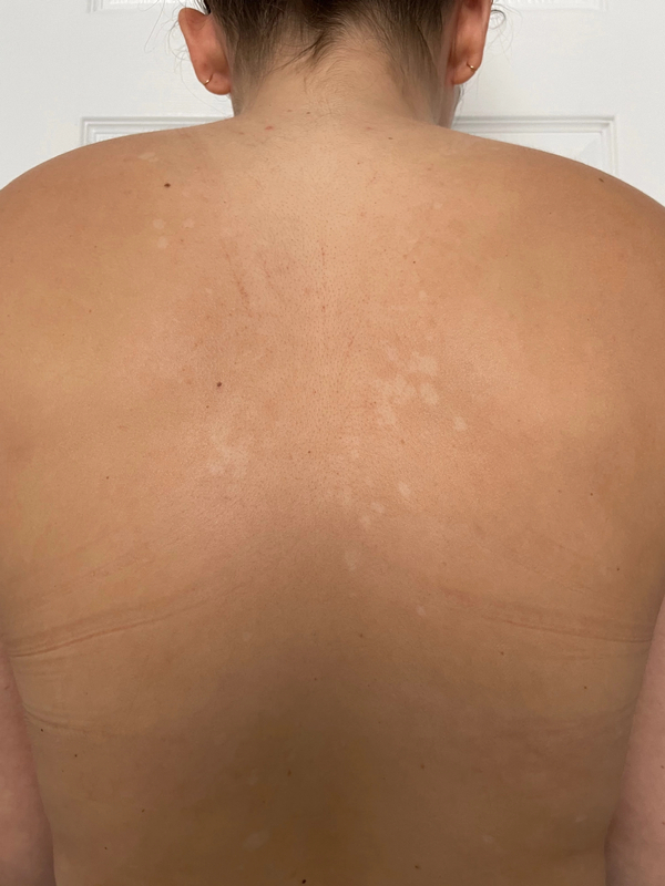 Tinea Versicolor Gallery—Pictures on Back, Chest, Butt Soft Services