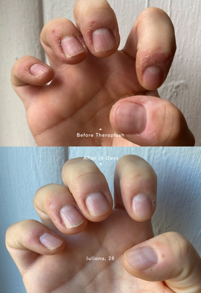 How to treat dry, flaky cuticles. Before and After Theraplush