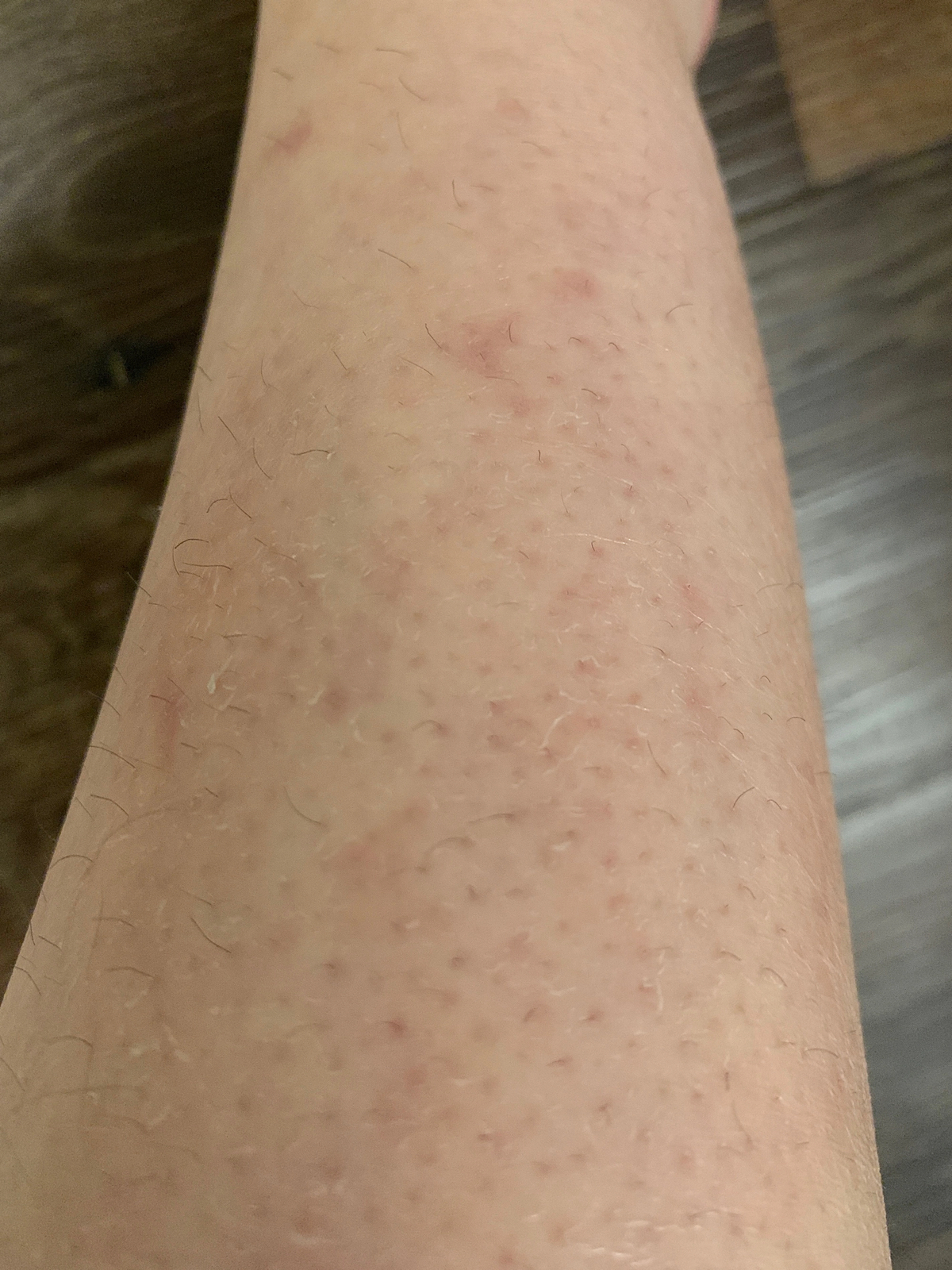 Dry Skin Image Gallery—Pictures on Hands, Legs Soft Services the body skin experts