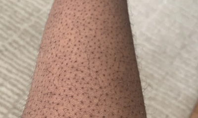 Strawberry skin on leg