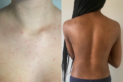 Body acne on different skin tones (left: light skin, right: dark skin)