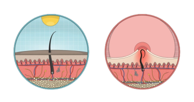 Illustration of a normal hair (left) and an ingrown hair (right)