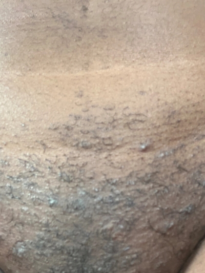 Ingrown Hair