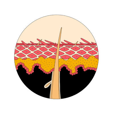 Illustration: Psoriasis causes skin cells on the body to build up rapidly—creating a thick, scaly-looking layer of skin cells that can become inflamed at the surface.