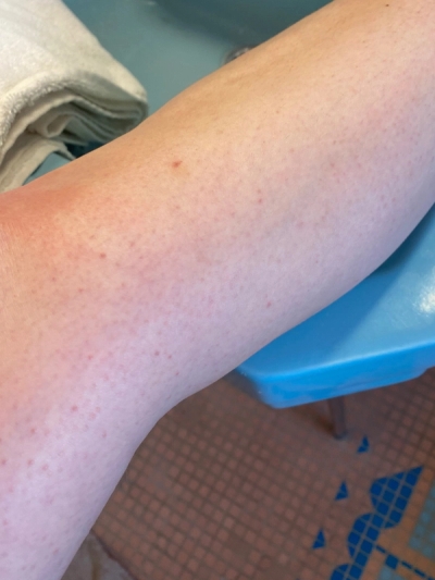 Keratosis Pilaris