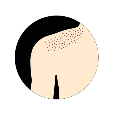 Illustration: Fungal “acne” will look uniform; all the bumps will be around the same size.