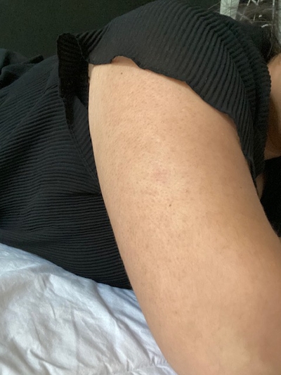 Keratosis Pilaris