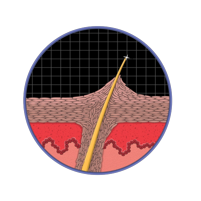 Illustration: KP is bumps of dead skin cells that form around the hair follicle