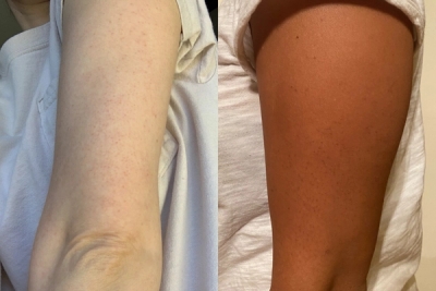 Keratosis Pilaris on light skin versus dark skin