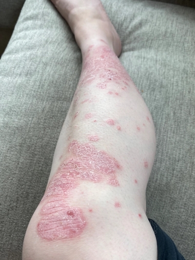 Psoriasis