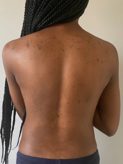 Body Acne, Scarring