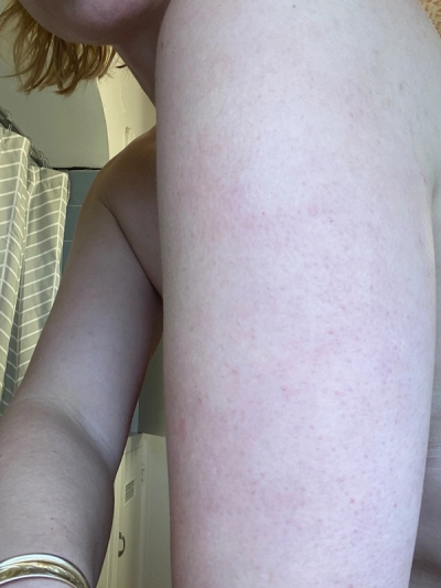 Keratosis Pilaris