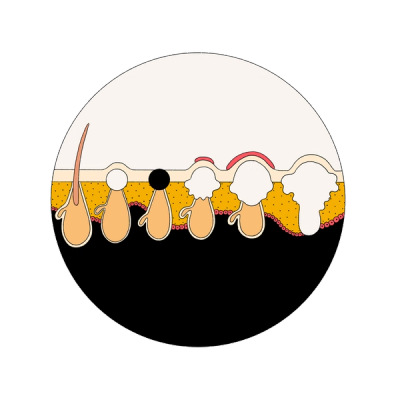 From left to right: healthy pore, whitehead, blackhead, papule, pustule, cyst/nodule