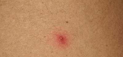 What does folliculitis look like