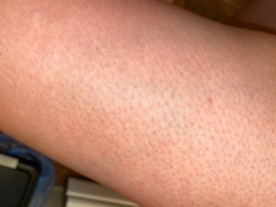 Keratosis Pilaris