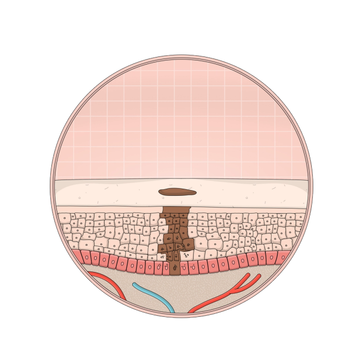 What Is The Difference Between Tinea Versicolor And Vitiligo? | Soft ...