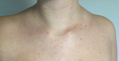 Body Acne on Chest