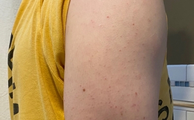 Keratosis Pilaris on upper arms