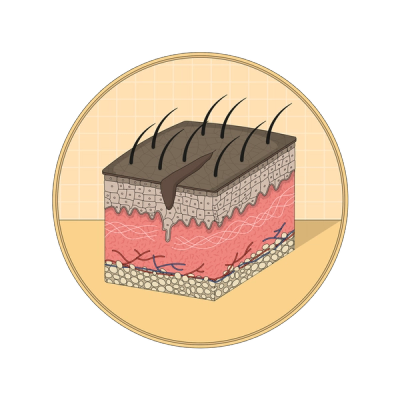 An illustration showing a stretch mark as a jagged tear in shin