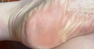 peeling, rough, weathered feet