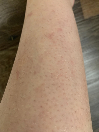 Dry Skin, Eczema