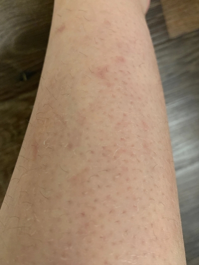Dry Skin, Eczema
