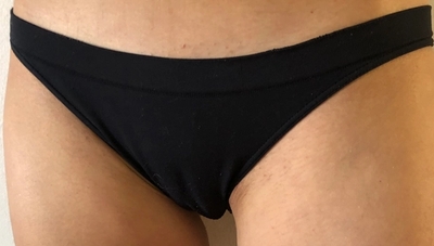 Ingrown hair in pubic area
