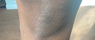 Knee discoloration