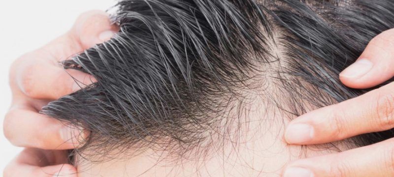 FUE Hair Transplant