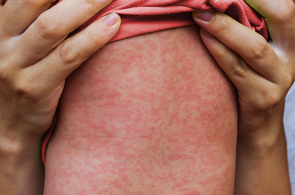 Anak Gatal Dan Kemerahan di Seluruh Badan? Waspada Gejala Campak