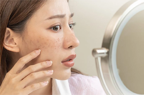 Wajah Muncul Bintik Hitam? Intip Perbedaan Melasma dan Flek Hitam