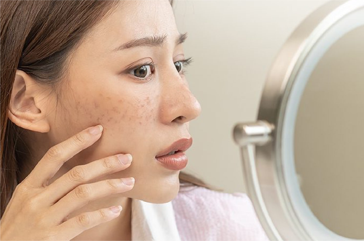 Wajah Muncul Bintik Hitam? Intip Perbedaan Melasma dan Flek Hitam