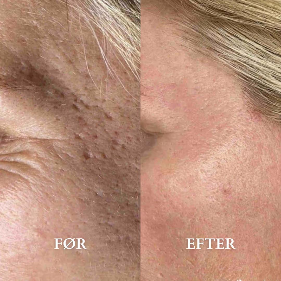 Før- og efterbillede af hud med akne ar og fine linjer efter microneedling behandling. 