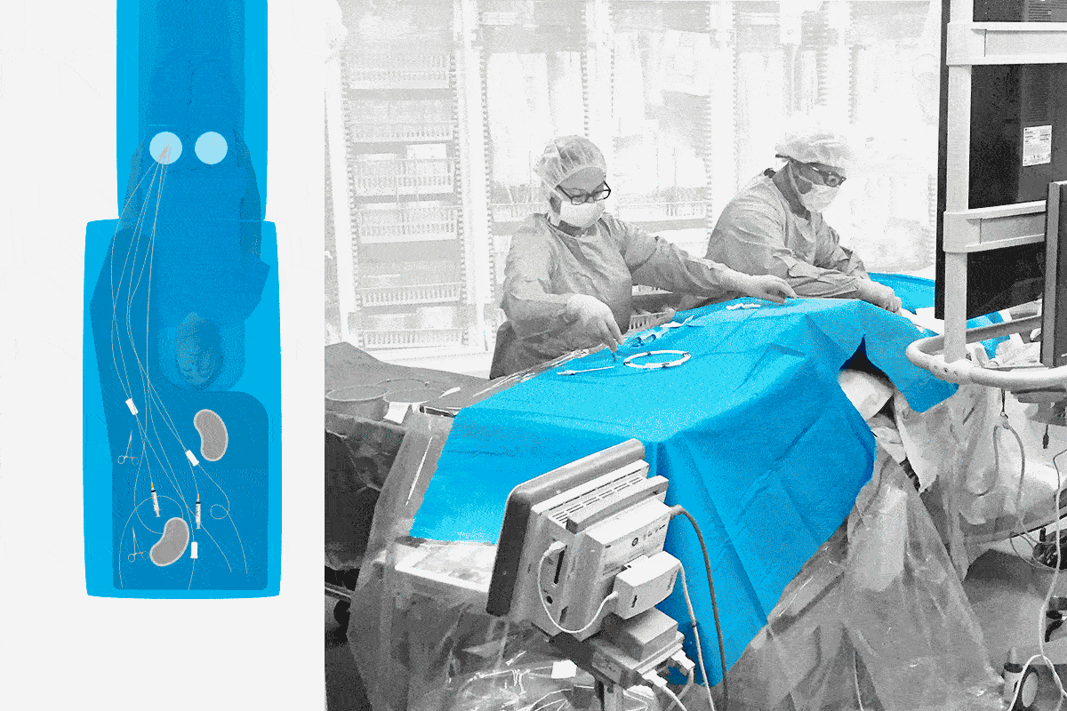 Split image: a blue anatomical diagram of brain and kidney nerve pathways beside a monochrome photo of two surgeons operating on a patient.