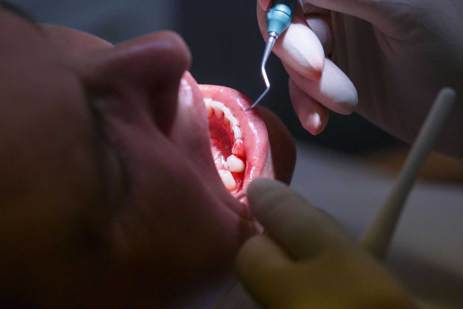 Bleeding or Swollen Gums