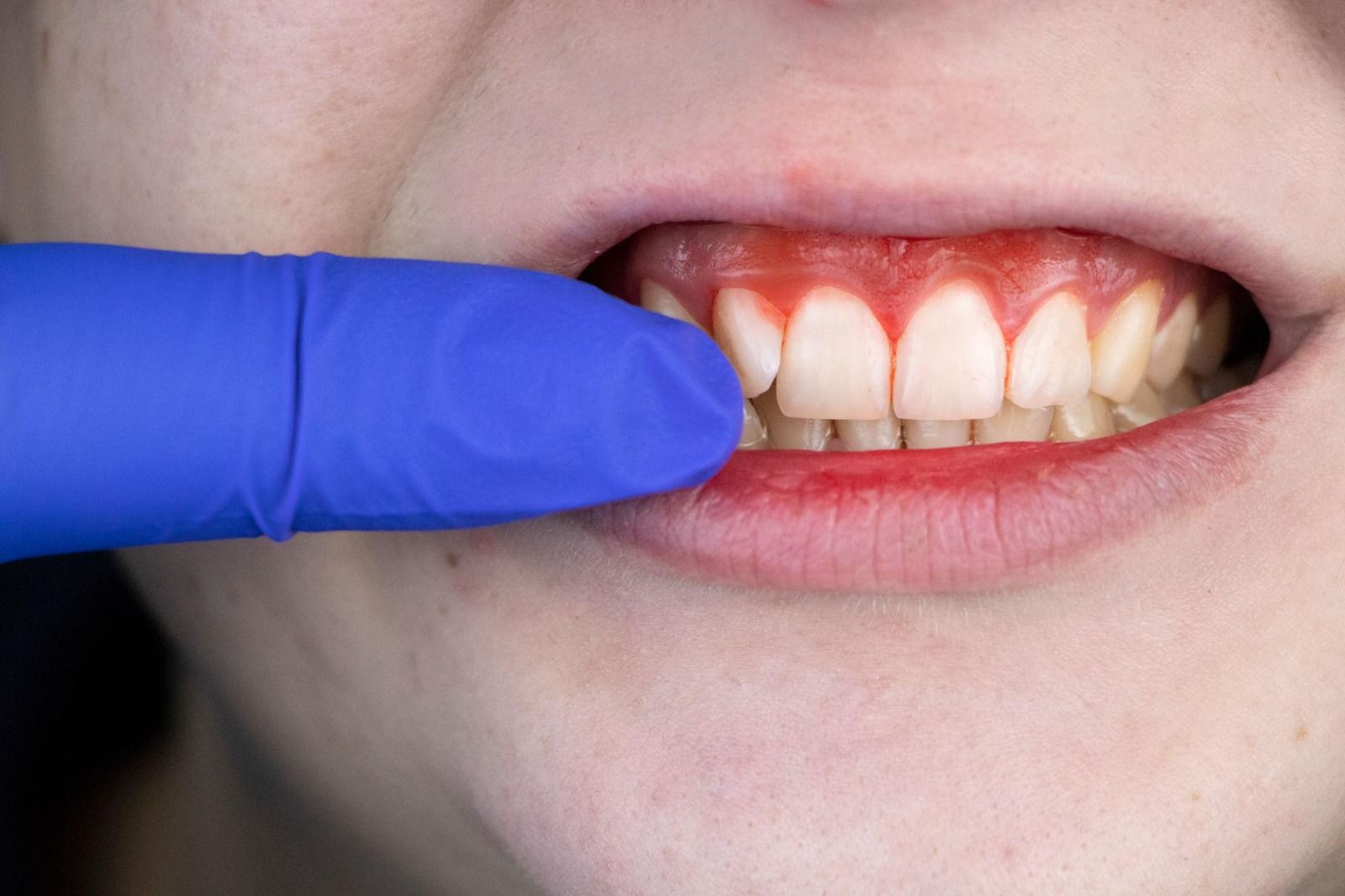 Bad Breath or Gum Infections