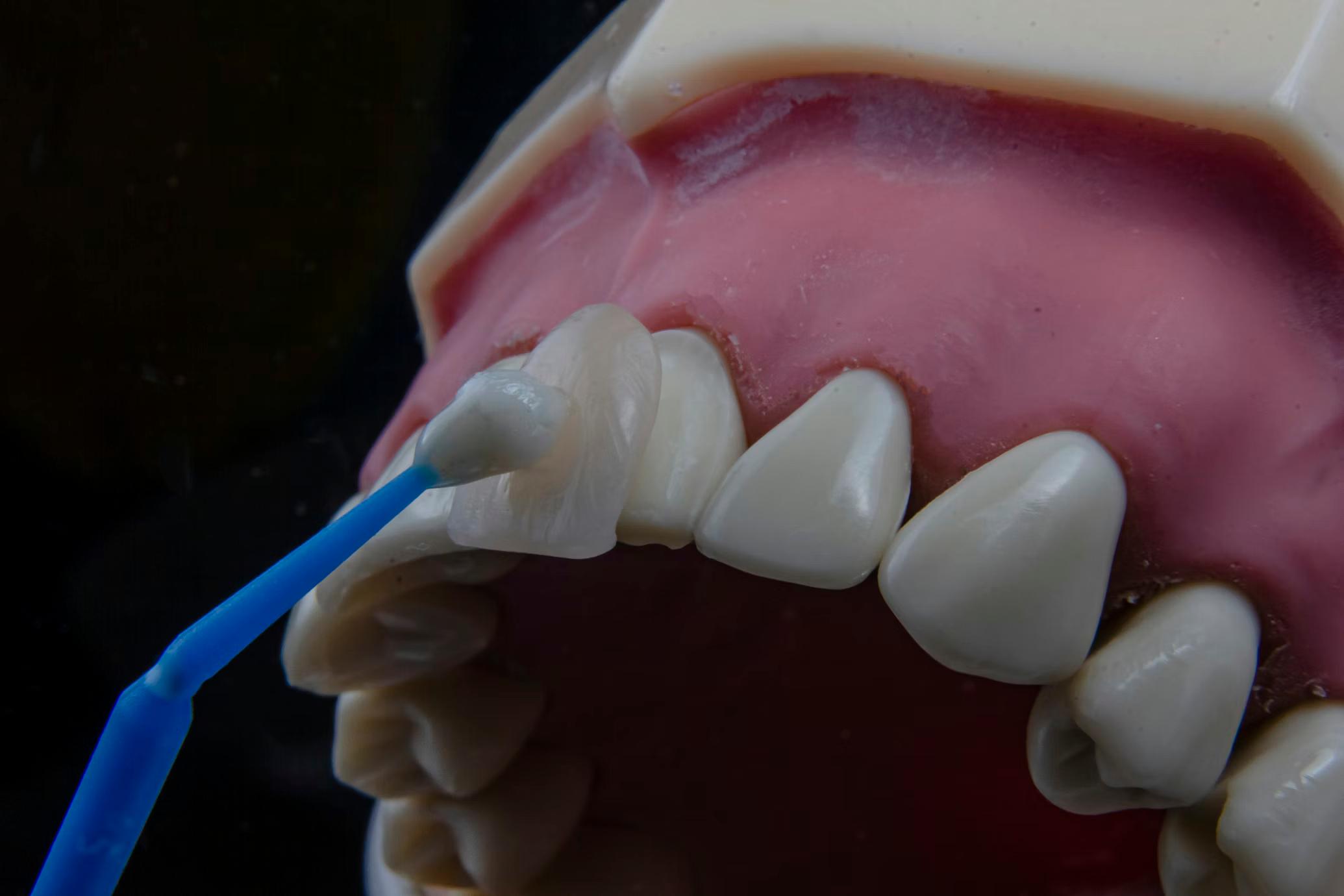 Scaling & Polishing