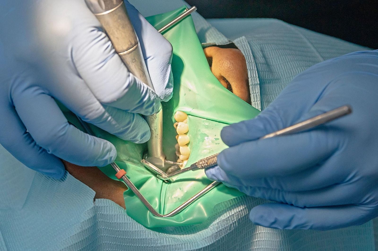 Dental Fillings