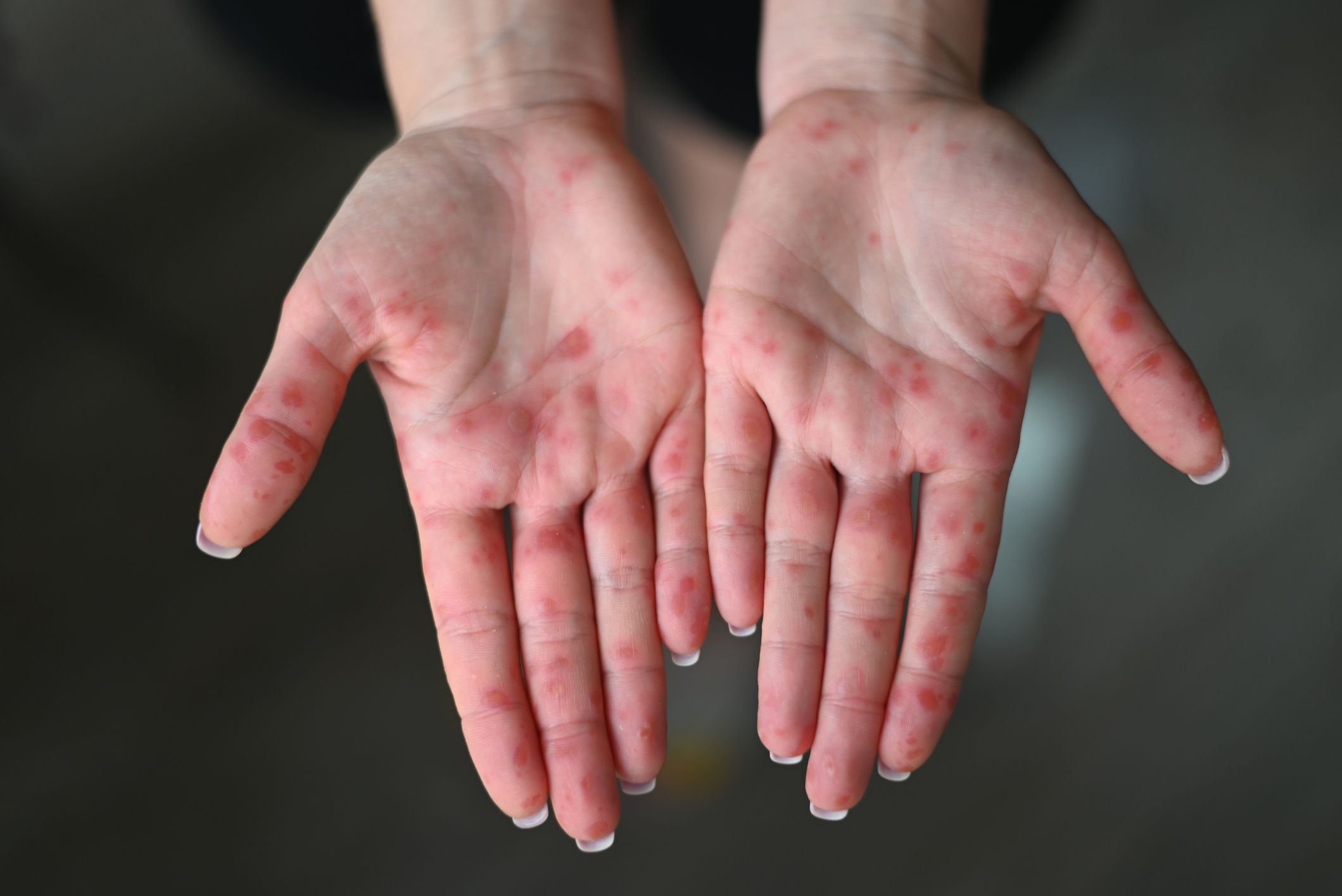 How Common is Hand, Foot and Mouth Disease in Adults?