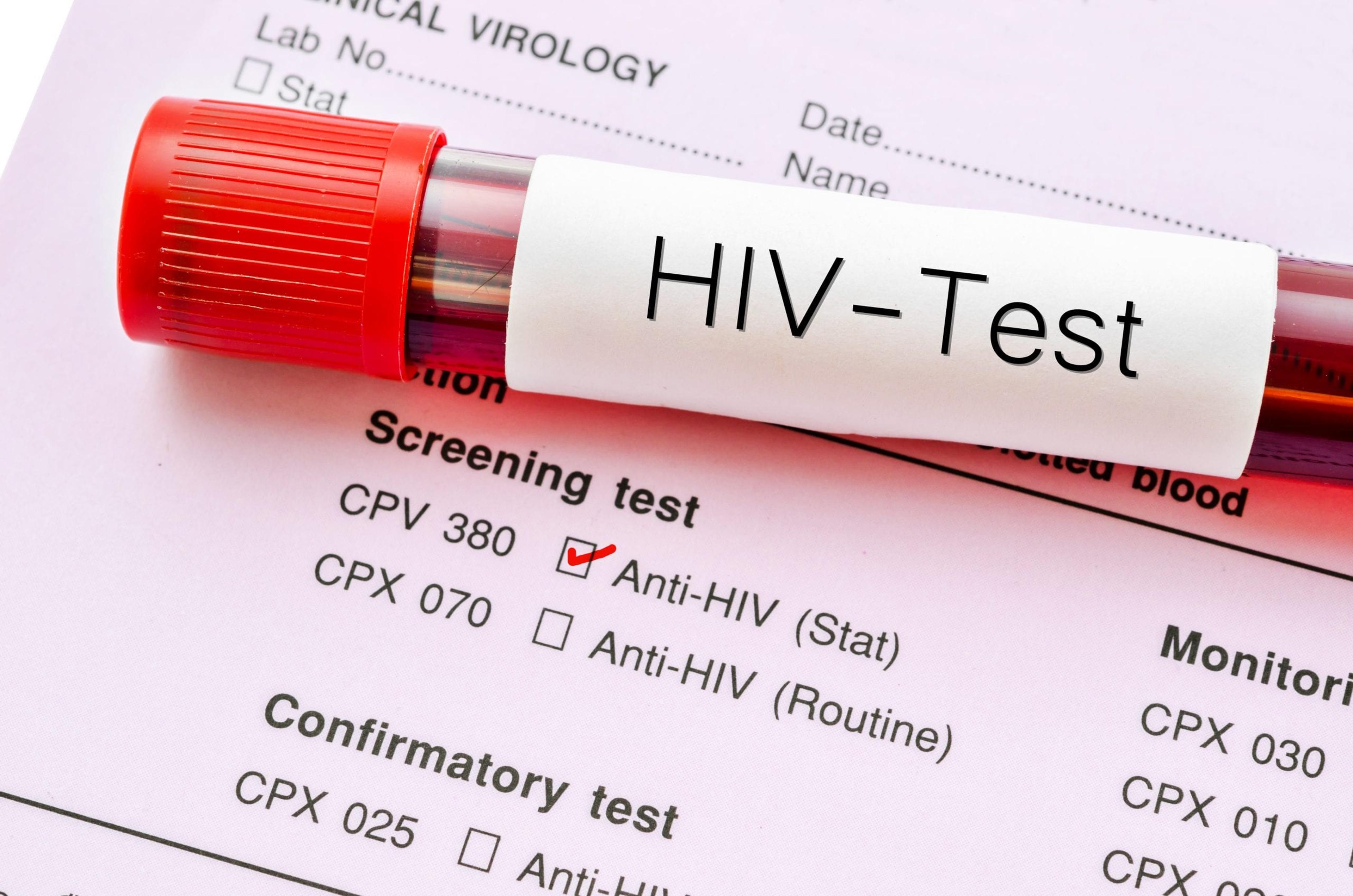 Sample blood collection tube with HIV test label