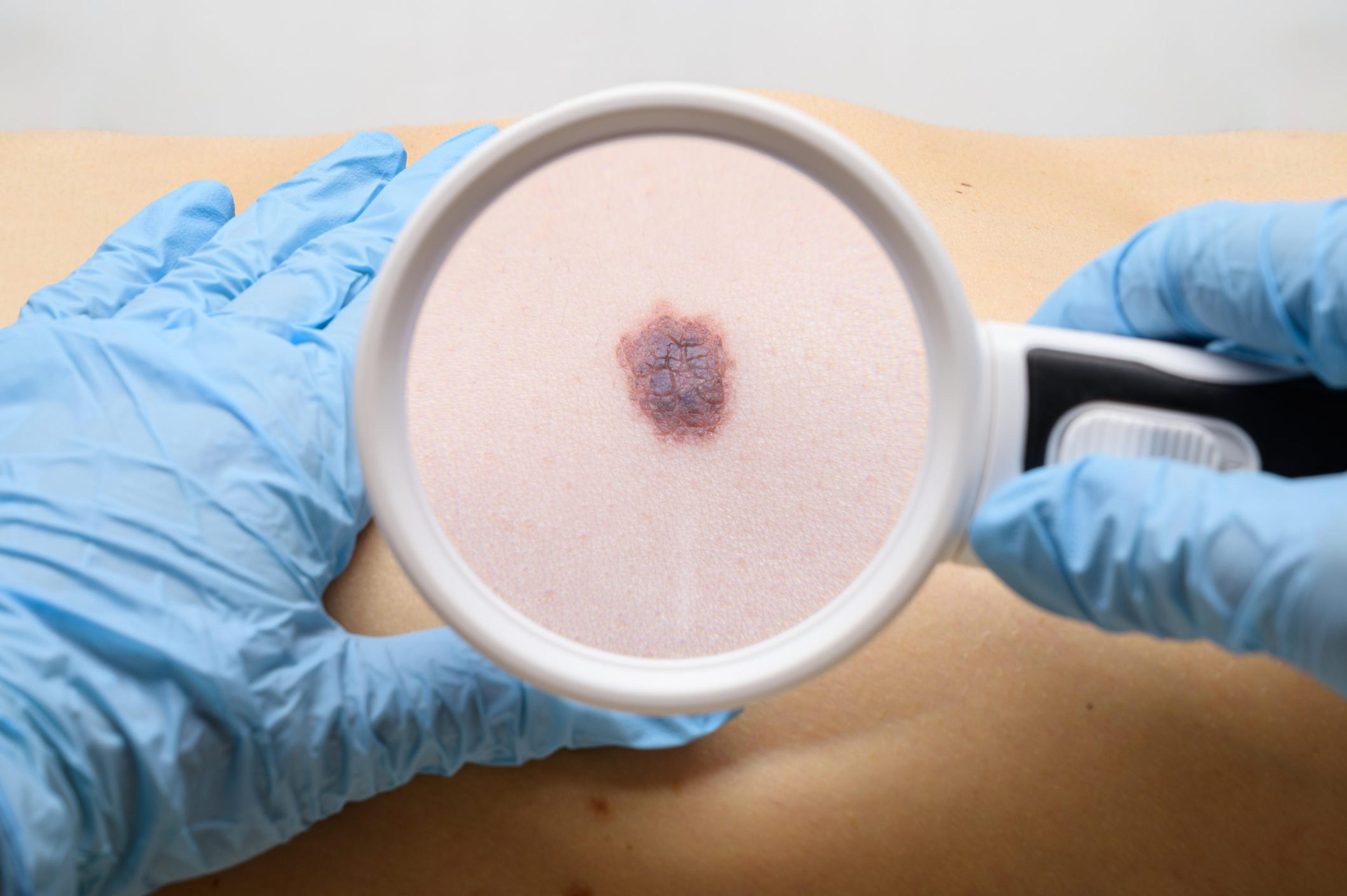 Examination of a mole on the patient's body. The concept of studying moles to prevent the development of skin cancer or melanoma.