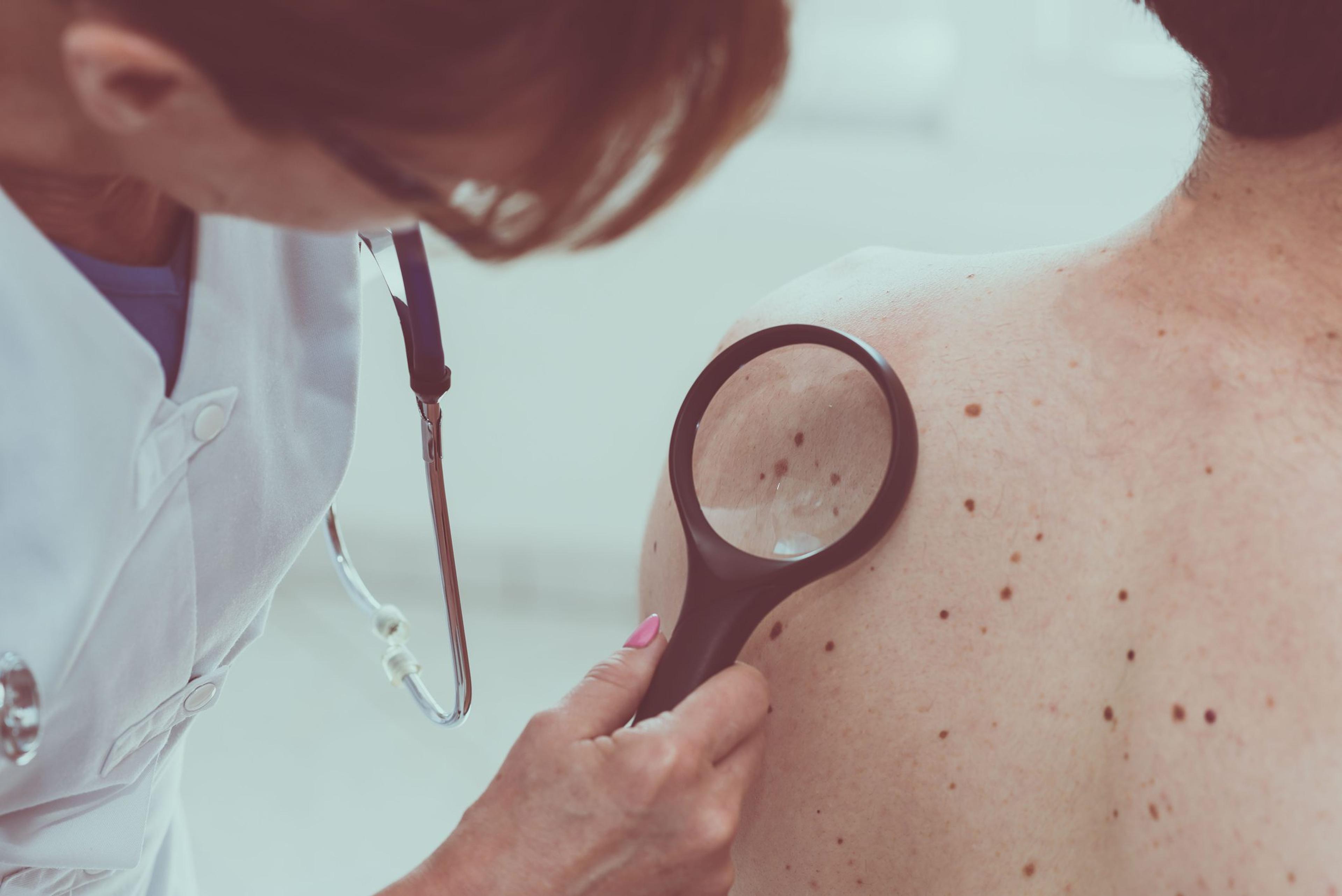 Dermatologist examining the skin of a patient looking at common sites for melanoma