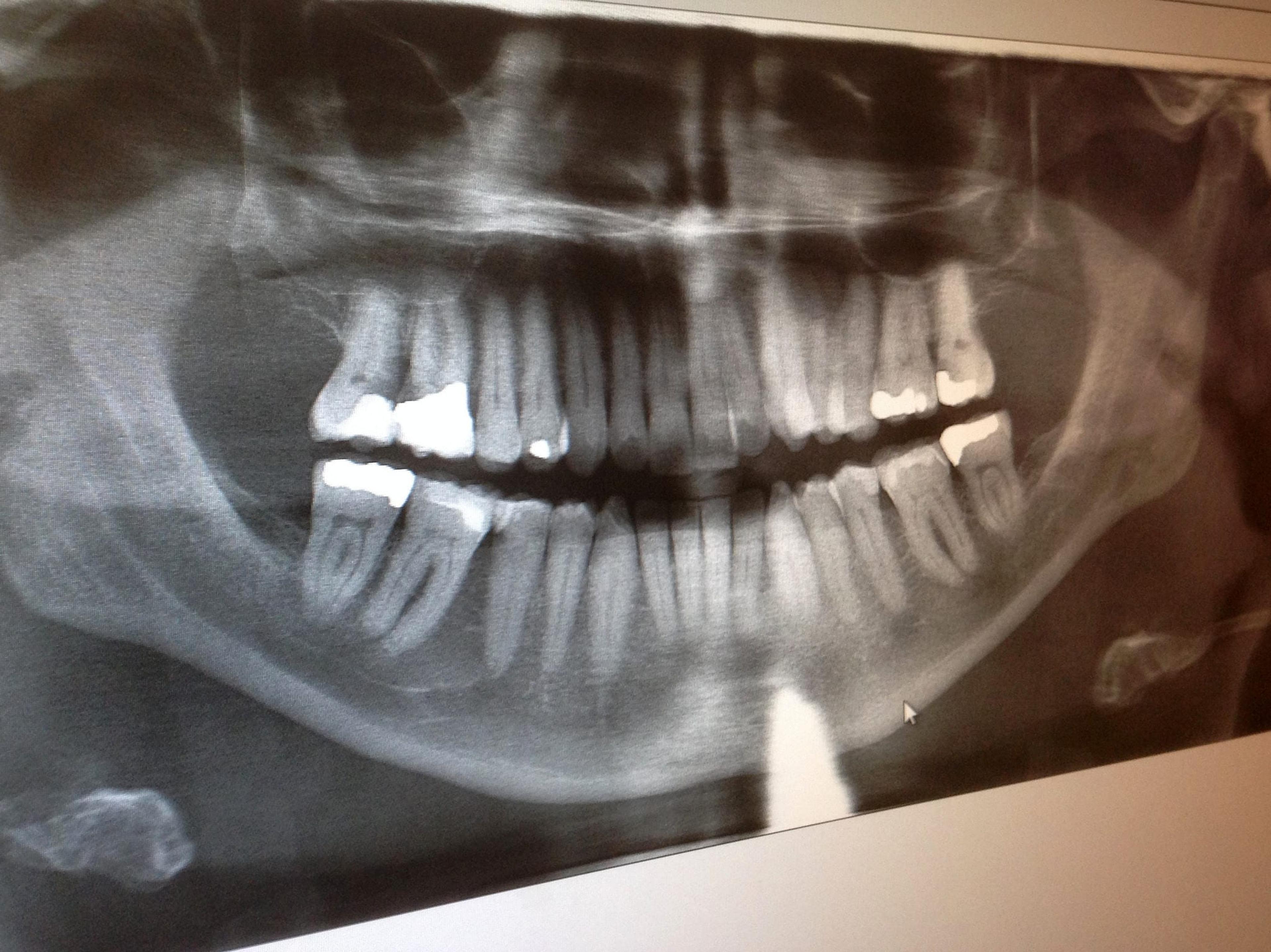 X-rays of Teeth