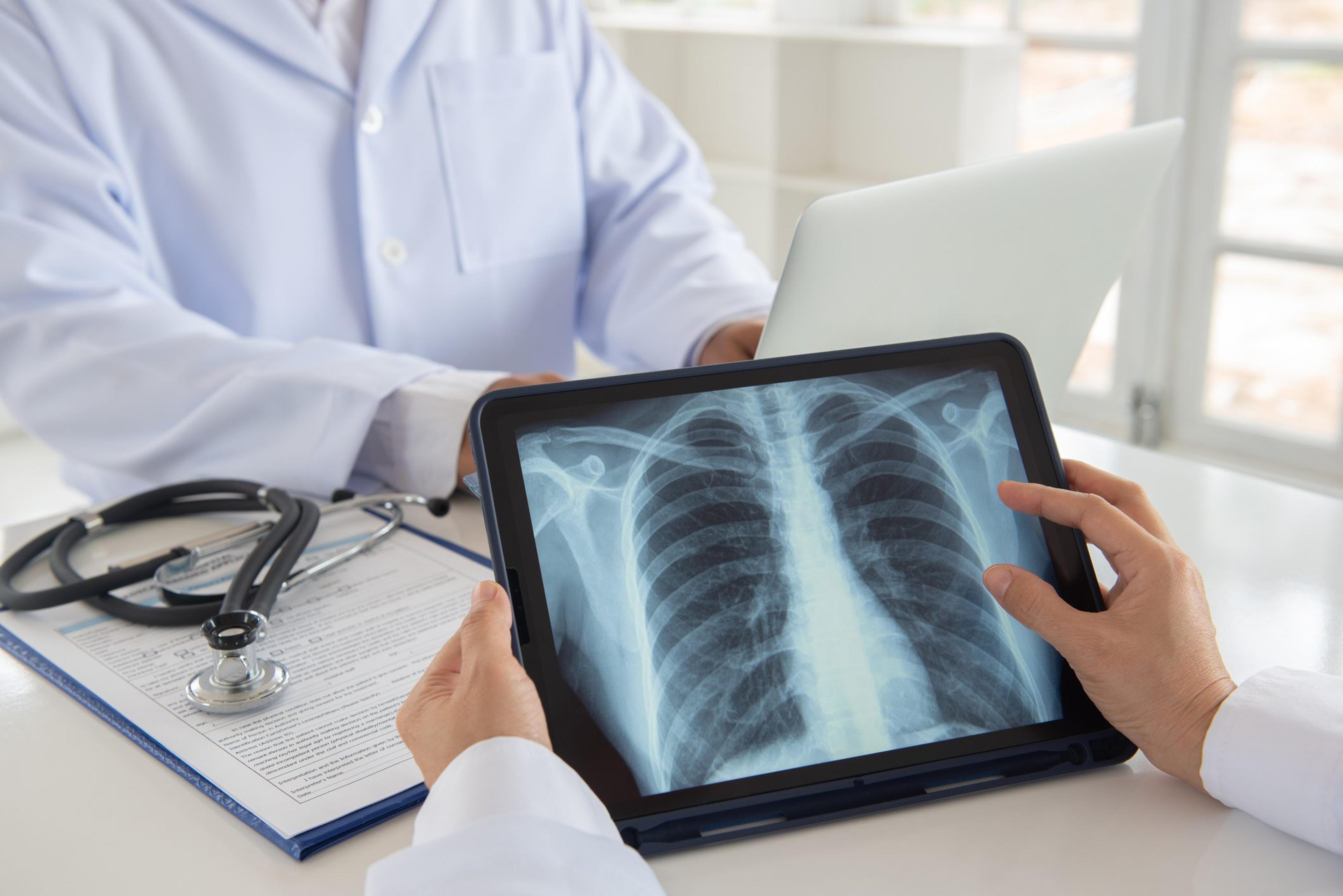 Doctor reviews X-ray during lung cancer screening