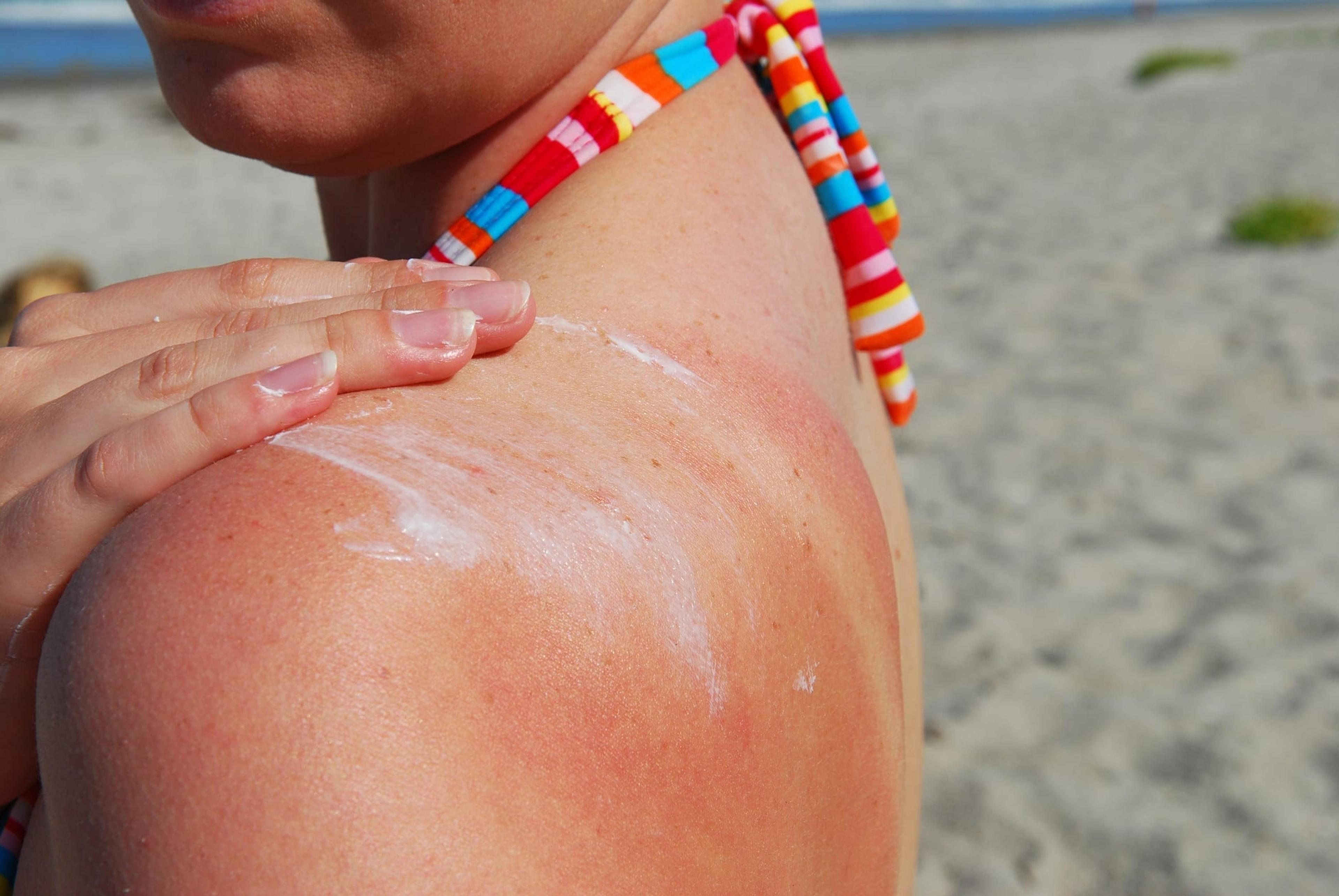Differences Between Sunburn, Sun Poisoning, Heat Rash, Heat Exhaustion