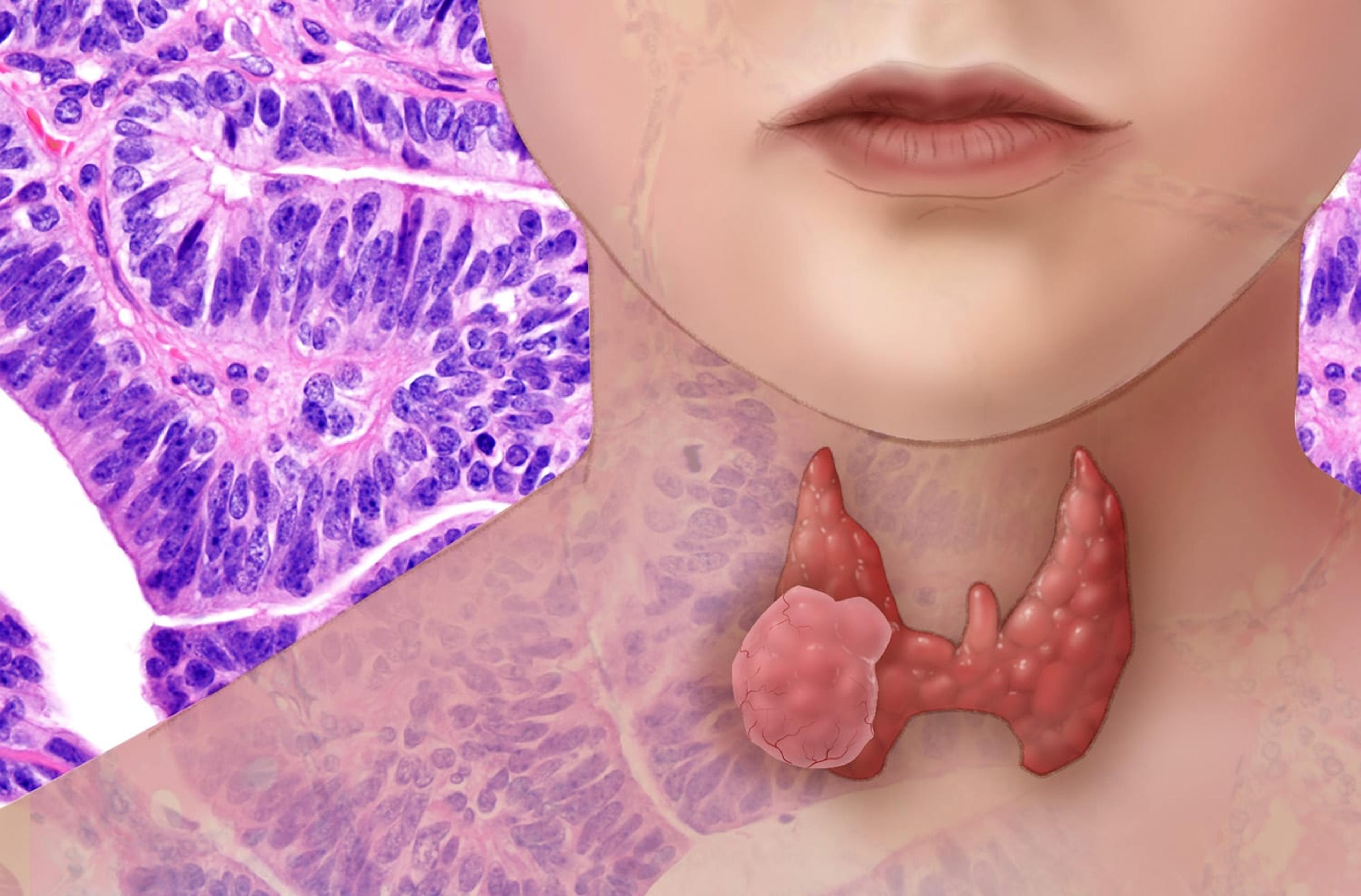 Illustration of thyroid cancer on a patient's neck